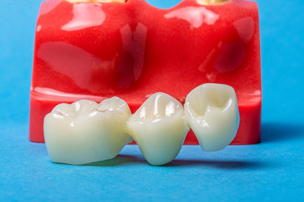 Dental Crowns & Bridges Dental Crowns & Bridges