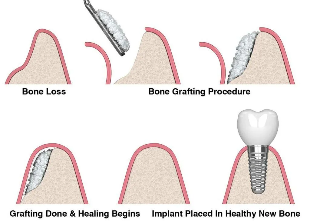 Bone Grafting