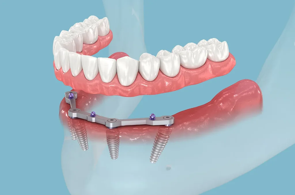 Hybridge Dental Implants