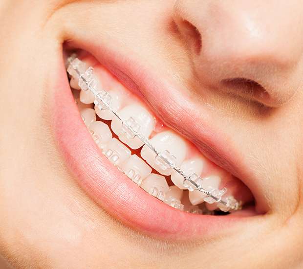 Lutz Clear Braces