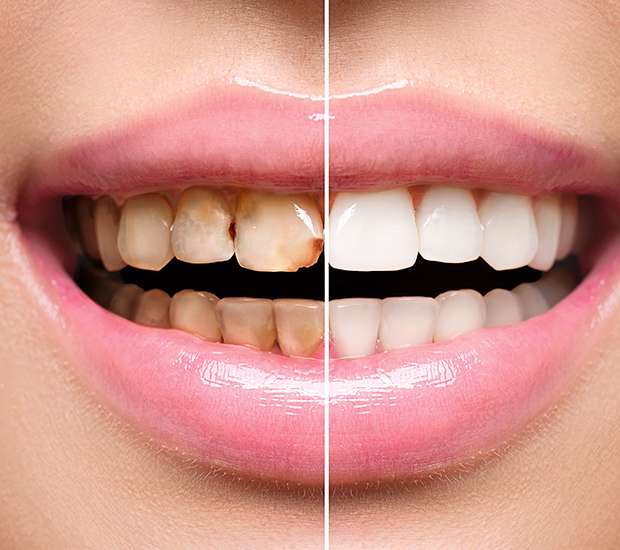 Lutz Dental Implant Restoration