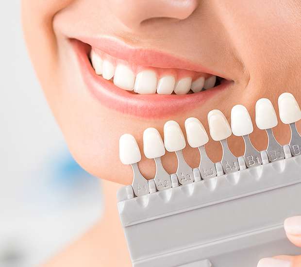 Lutz Dental Veneers and Dental Laminates